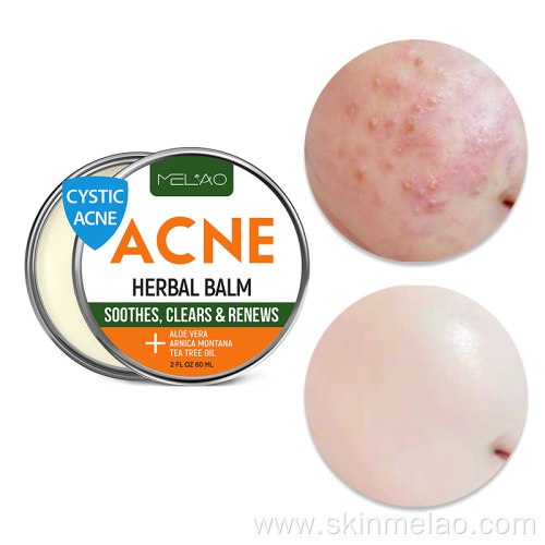 Pimple Repair Scar Acne Treatment Cream